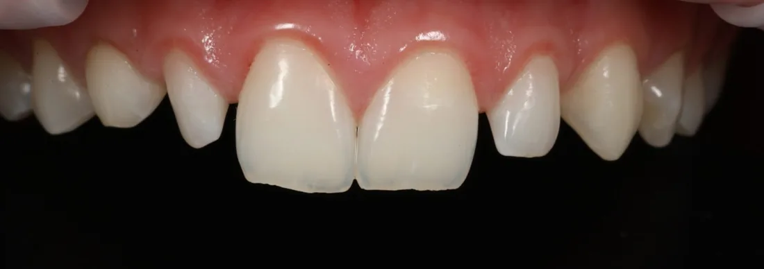 Before treatment: a patient's upper and lower front teeth, seen straight on