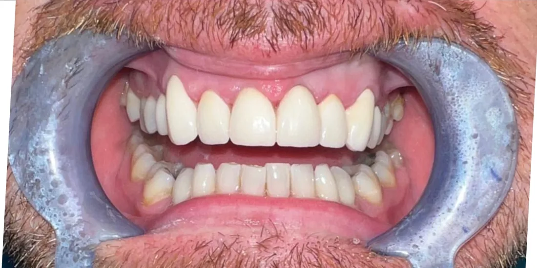 After treatment: a patient's front teeth with the lips held back