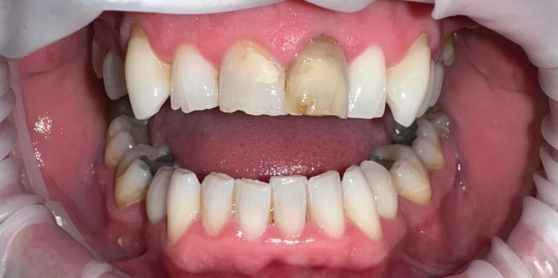 Before treatment: a patient's front teeth with the lips held back