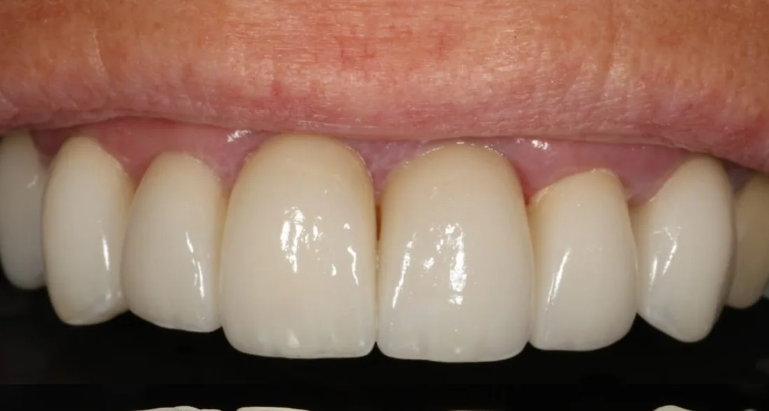 After treatment: the side view of a patient's upper and lower teeth