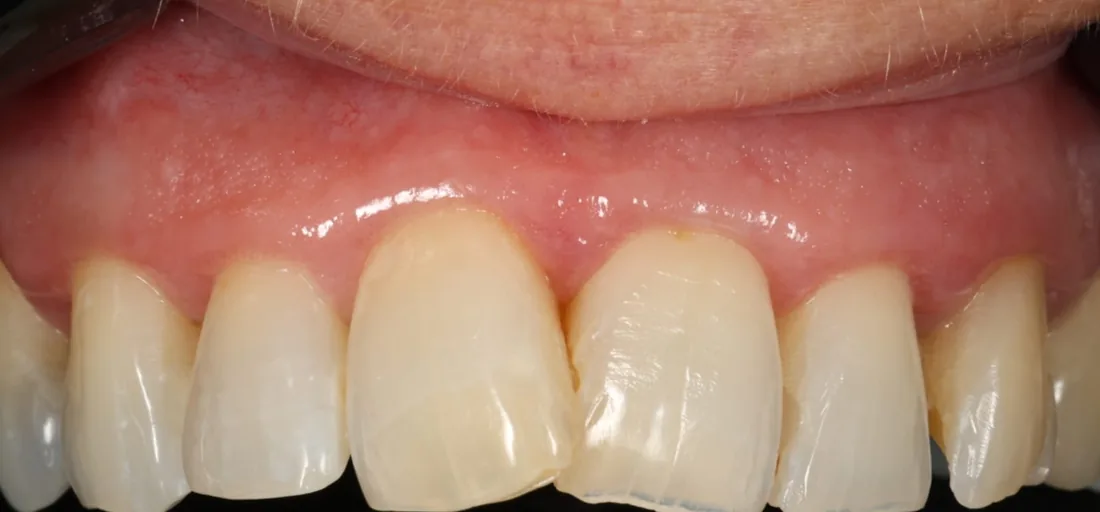 Before treatment: the side view of a patient's upper and lower teeth