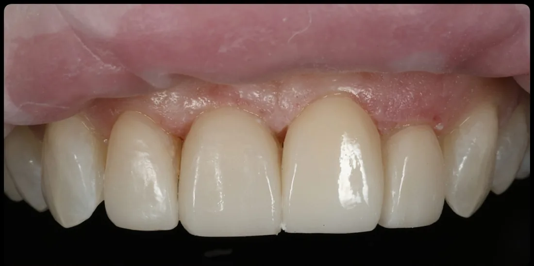 After treatment: a close-up of a patient's upper front teeth