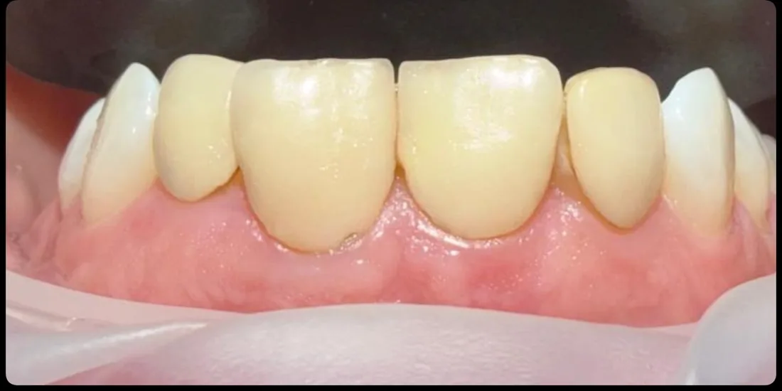Before treatment: a close-up of a patient's upper front teeth