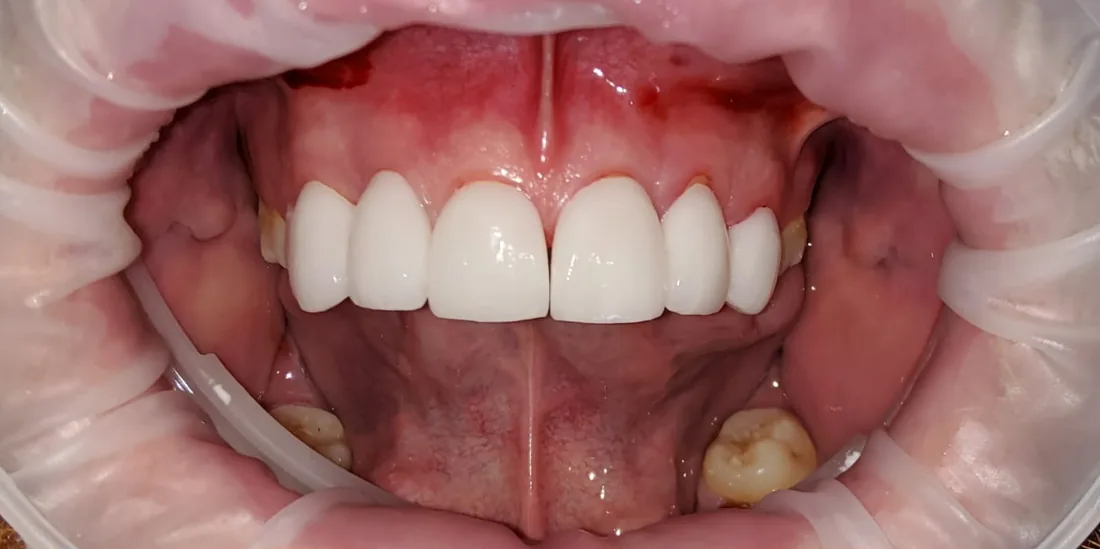 After treatment: a patient's front teeth with the lips held back