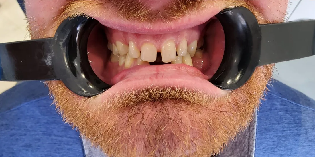 Before treatment: a patient's front teeth with the lips held back