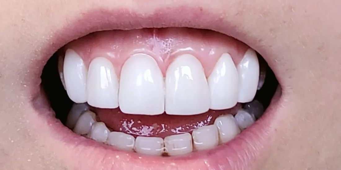 After treatment: a patient's upper and lower front teeth