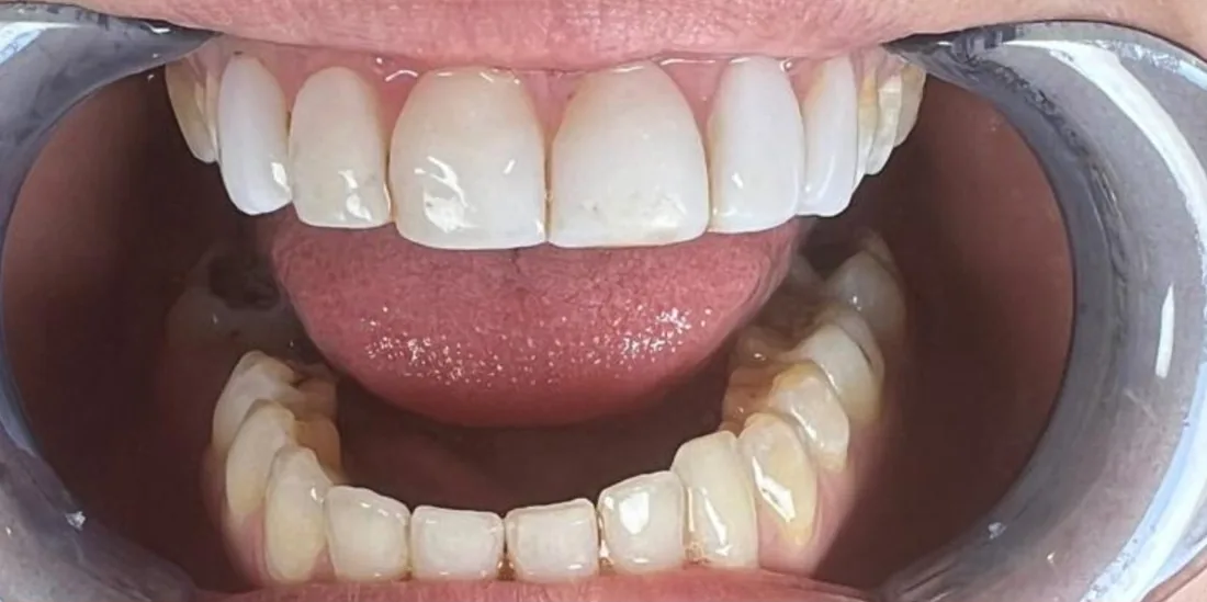 Before treatment: a patient's upper and lower front teeth