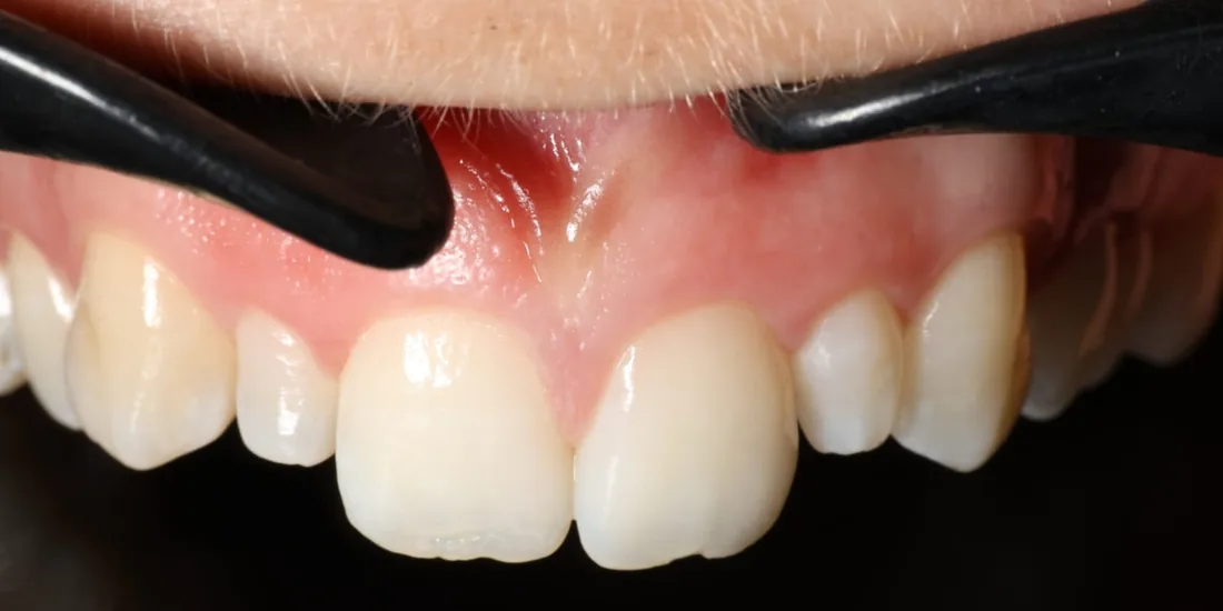 After treatment: the side view of a patient's upper and lower teeth