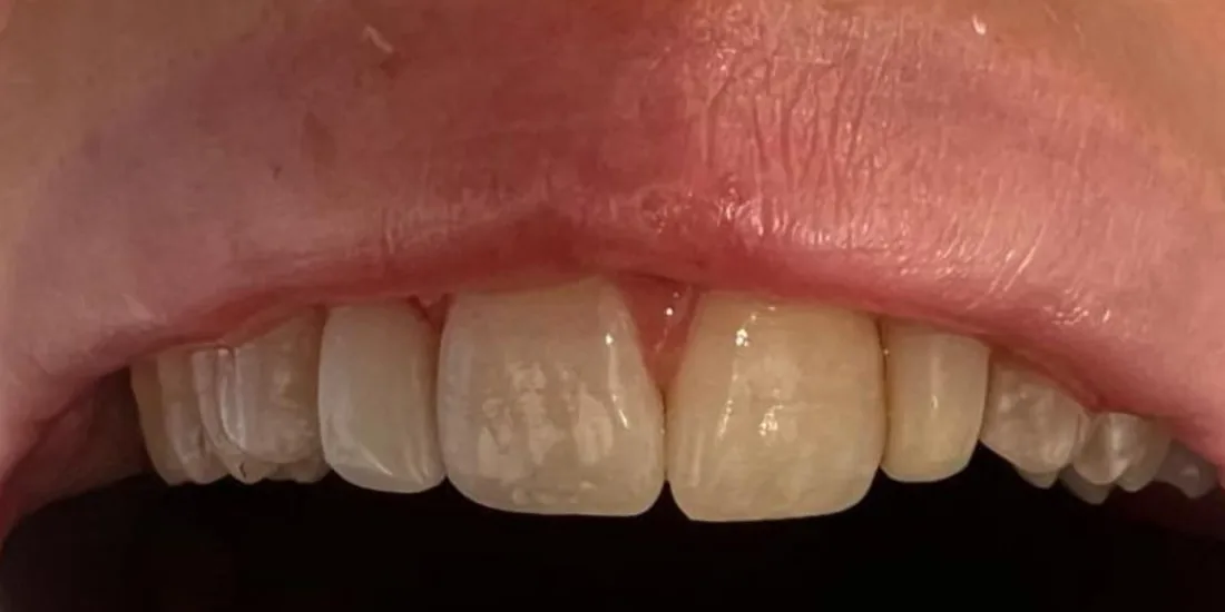 Before treatment: the side view of a patient's upper and lower teeth