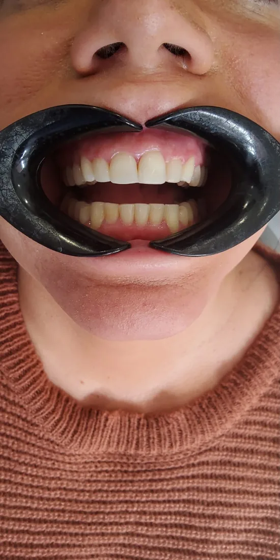 After treatment: a patient's front teeth with the lips held back