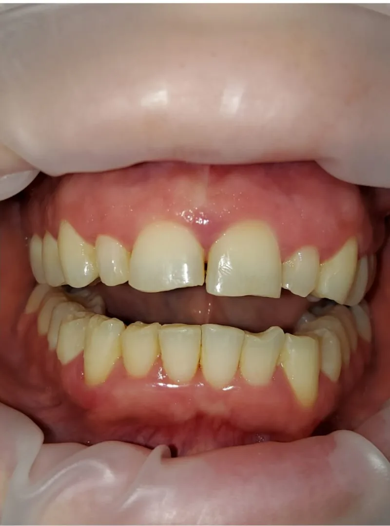 Before treatment: a patient's front teeth with the lips held back