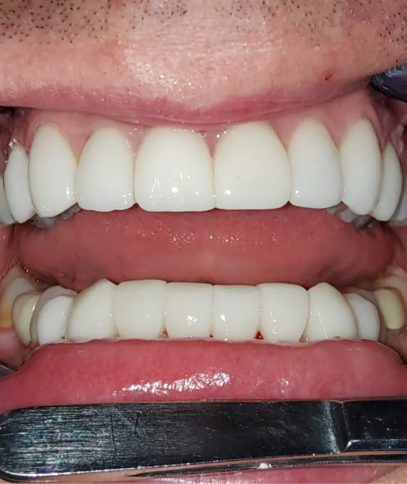 After treatment: a patient's upper and lower front teeth