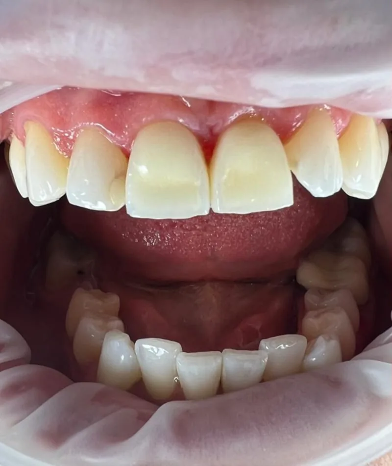 Before treatment: a patient's upper and lower front teeth