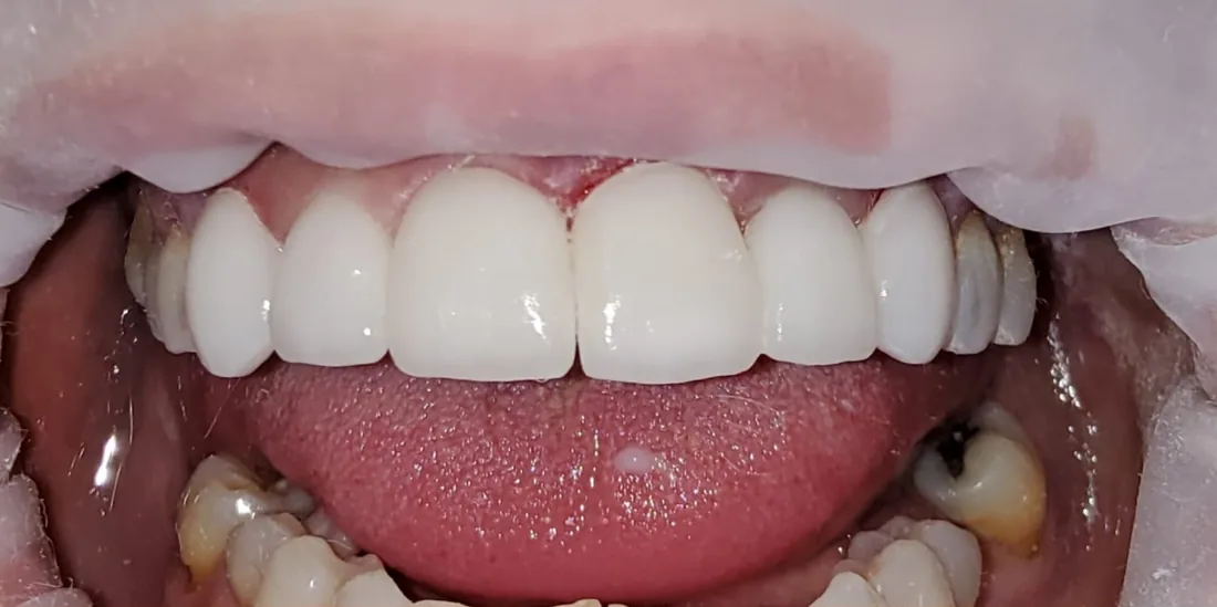 After treatment: a patient's front teeth with the lips held back