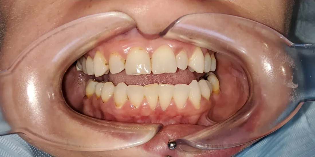 Before treatment: a patient's front teeth with the lips held back