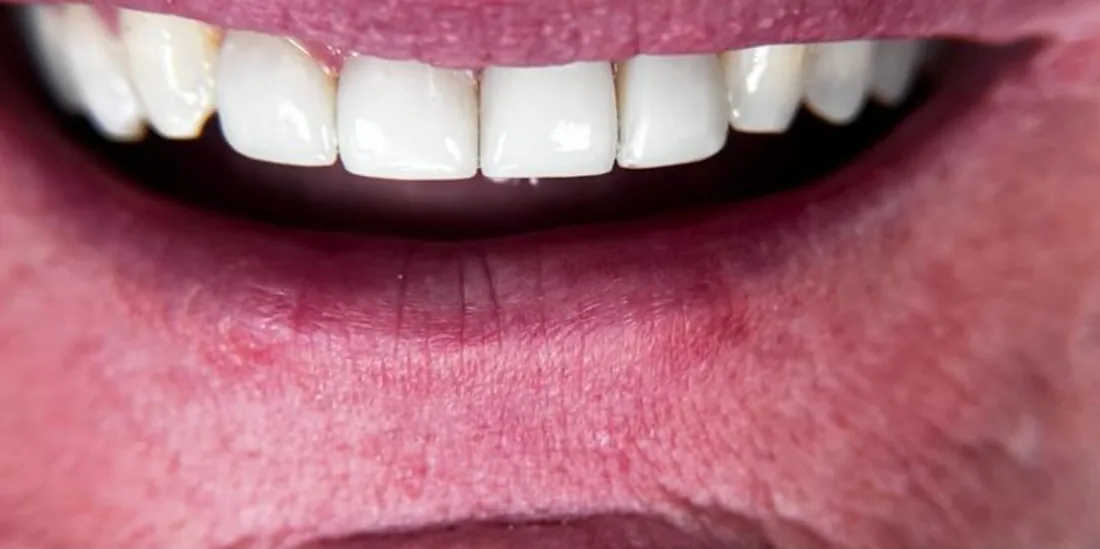 After treatment: a patient's upper front teeth
