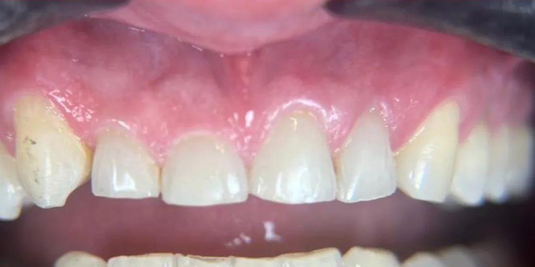 Before treatment: a patient's upper front teeth