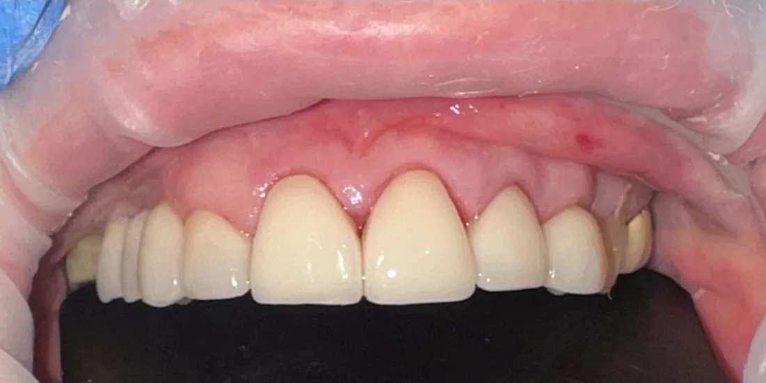 After treatment: a close-up of a patient's upper front teeth