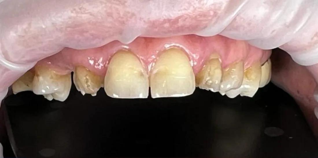 Before treatment: a close-up of a patient's upper front teeth