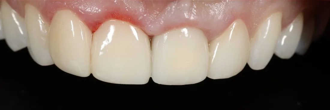 After treatment: a close-up of a patient's upper front teeth