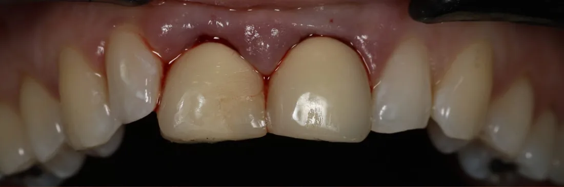 Before treatment: a close-up of a patient's upper front teeth