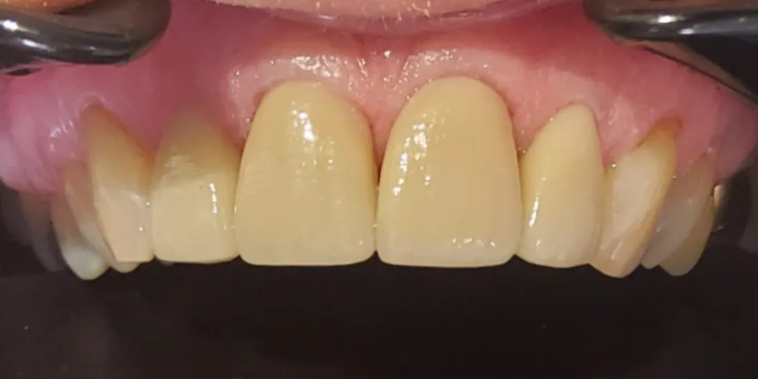 After treatment: the side view of a patient's upper and lower teeth
