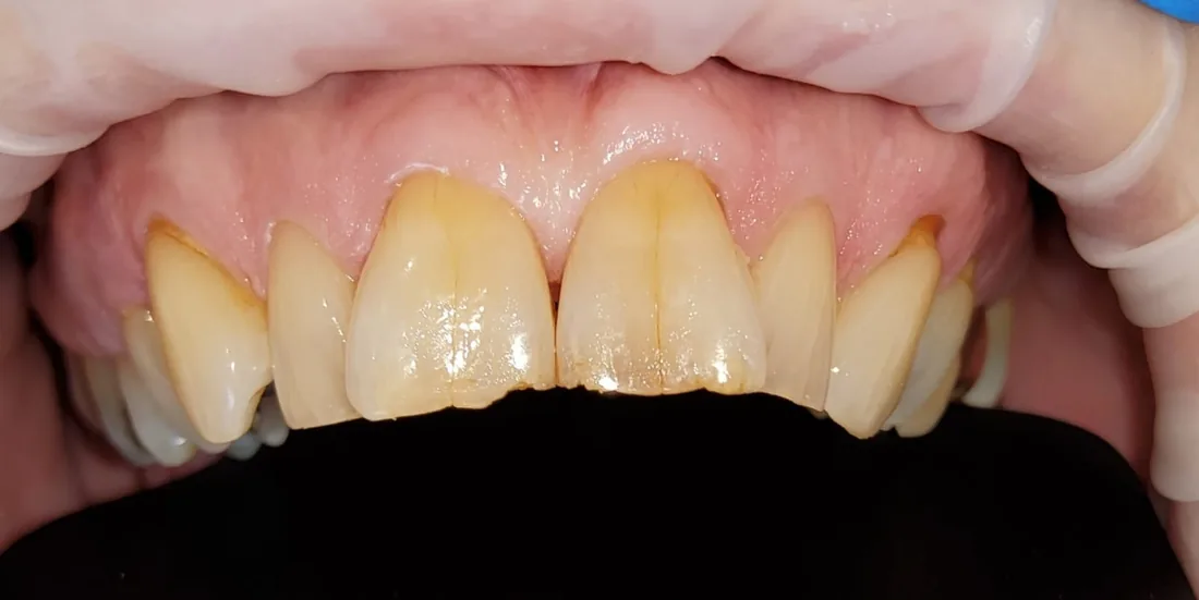 Before treatment: the side view of a patient's upper and lower teeth