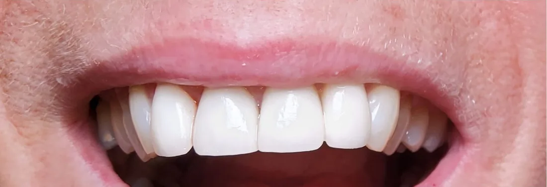 After treatment: a patient's upper and lower teeth