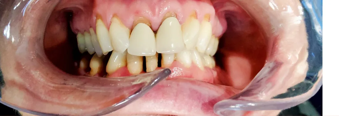Before treatment: a patient's upper and lower teeth