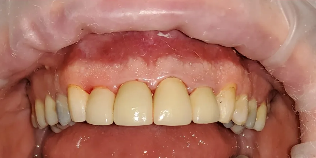 After treatment: a patient's upper and lower front teeth