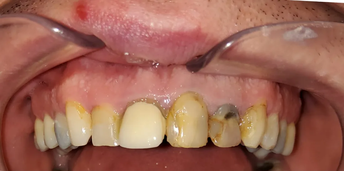 Before treatment: a patient's upper and lower front teeth