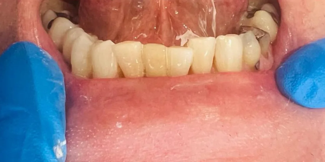 After treatment: a patient's lower front teeth