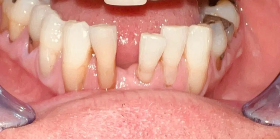 Before treatment: a patient's lower front teeth