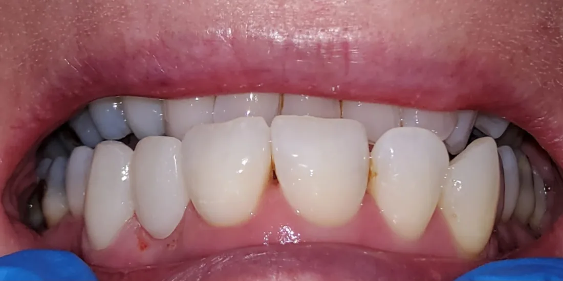 After treatment: the side view of a patient's upper and lower teeth