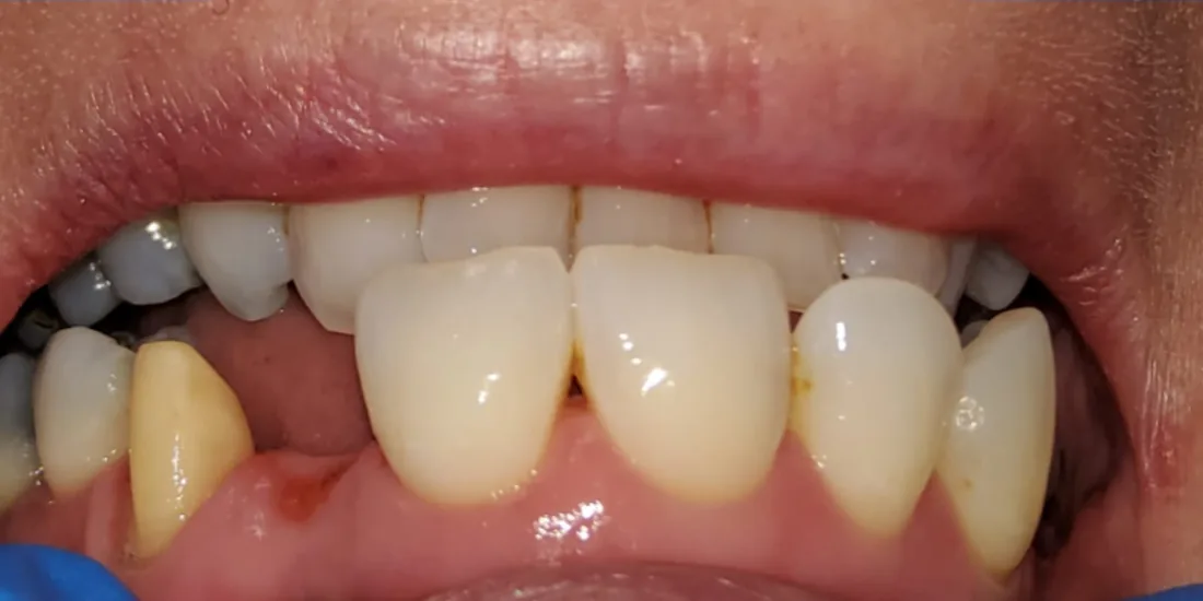 Before treatment: the side view of a patient's upper and lower teeth