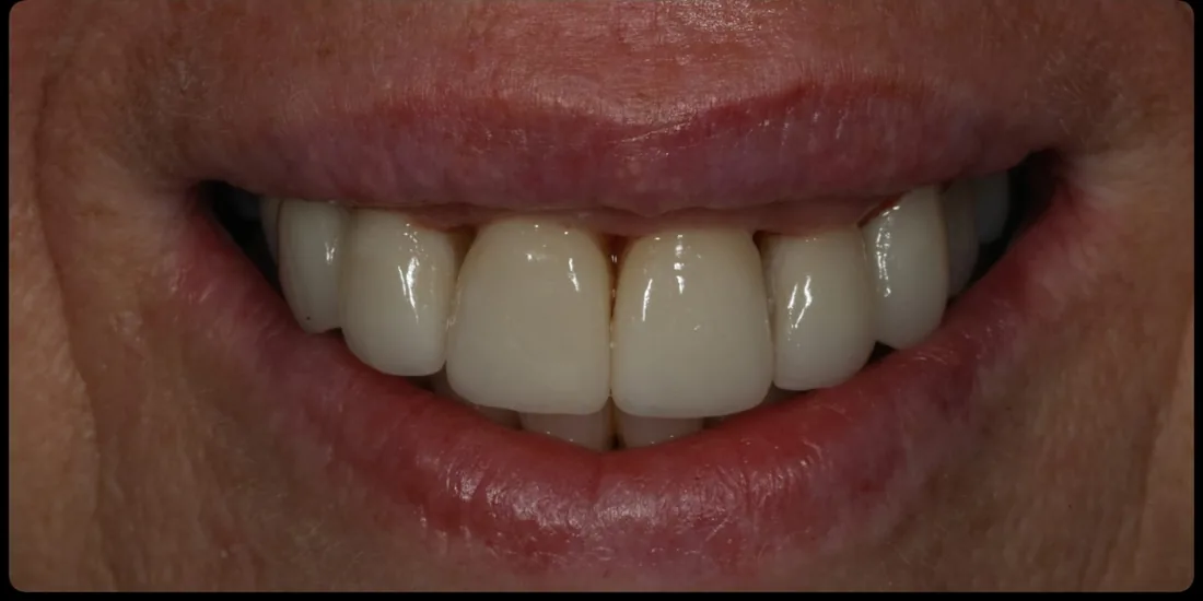 After treatment: a close-up of a patient's upper front teeth
