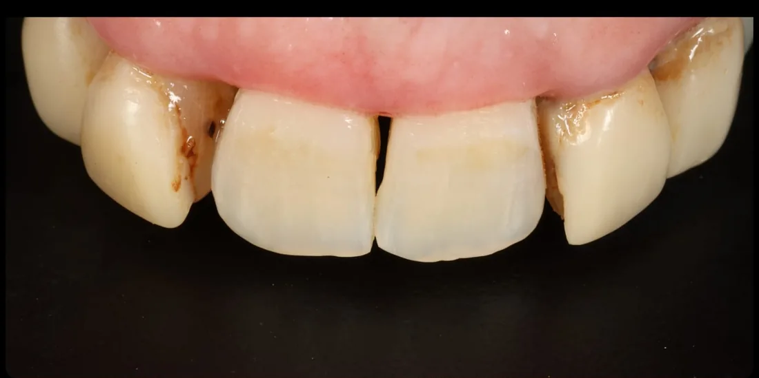 Before treatment: a close-up of a patient's upper front teeth