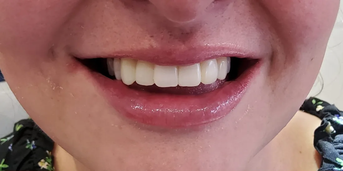 After treatment: a patient's upper and lower front teeth