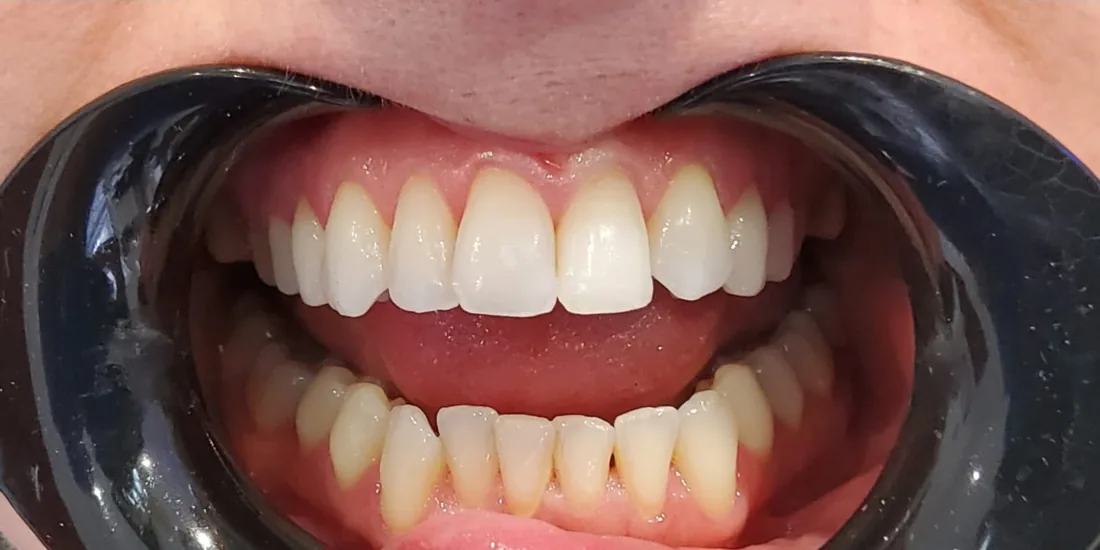 Before treatment: a patient's upper and lower front teeth