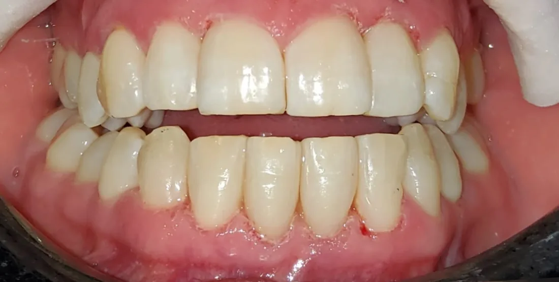 After treatment: a patient's upper and lower front teeth