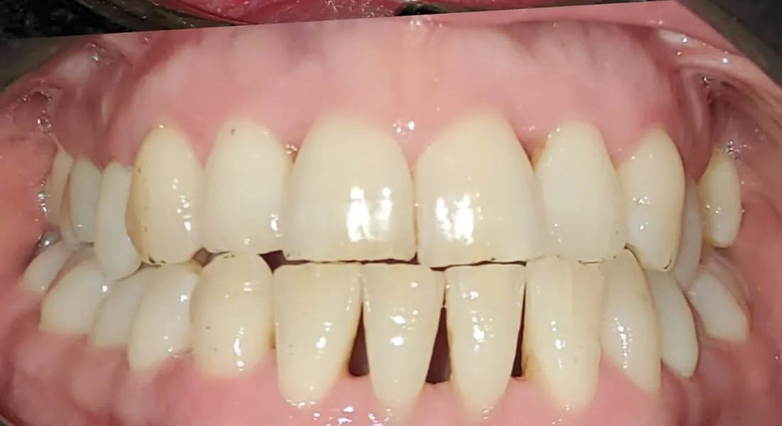 Before treatment: a patient's upper and lower front teeth