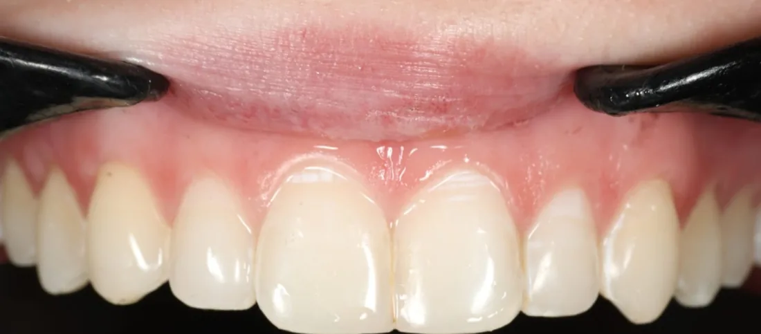 After treatment: the side view of a patient's upper and lower teeth