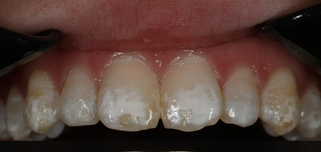 Before treatment: the side view of a patient's upper and lower teeth