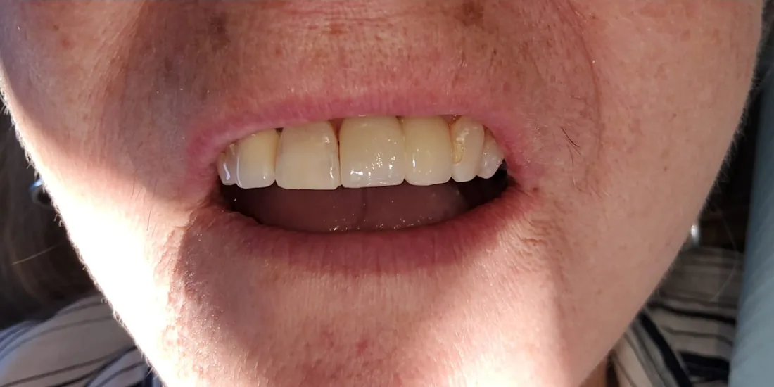 After treatment: a patient's upper and lower front teeth