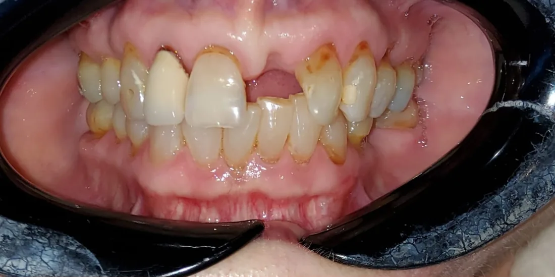 Before treatment: a patient's upper and lower front teeth