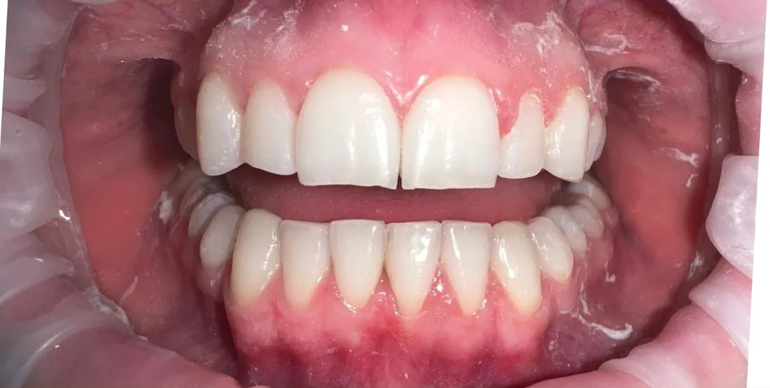 After treatment: a patient's upper and lower front teeth