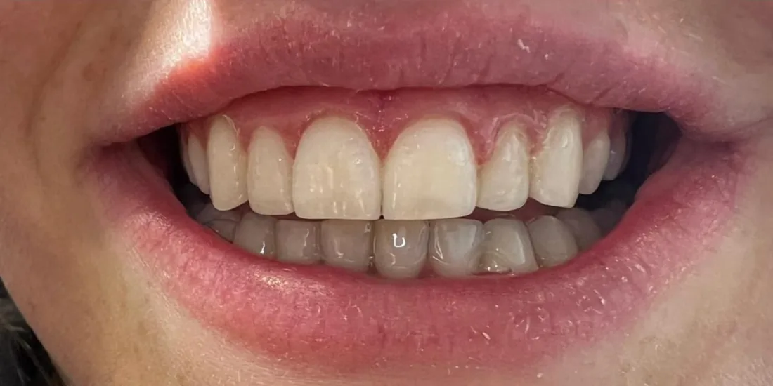 Before treatment: a patient's upper and lower front teeth