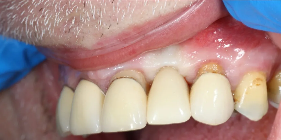 After treatment: a close-up of the side of a patient's upper teeth, with a gap where a tooth is missing