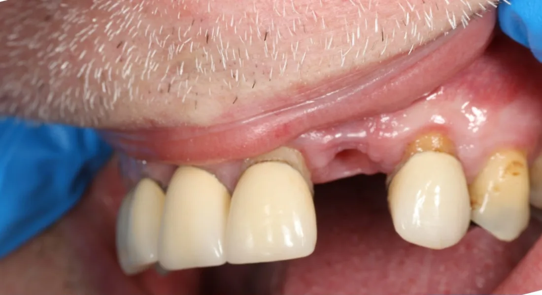 Before treatment: a close-up of the side of a patient's upper teeth, with a gap where a tooth is missing