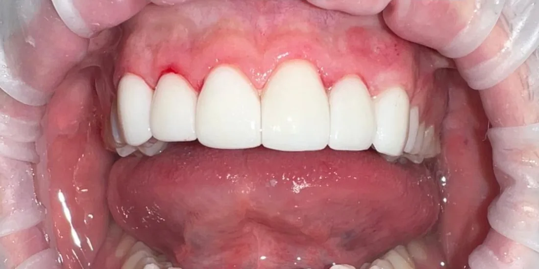 After treatment: a patient's upper front teeth with the lips held back